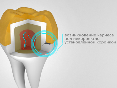 Портятся ли зубы под коронкой?
