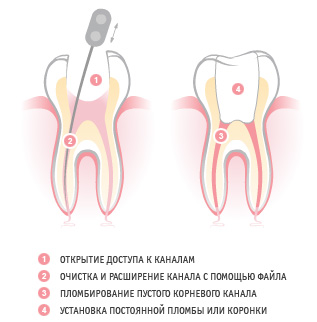 Лечение корневого канала
