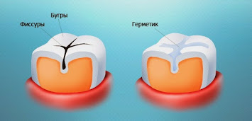 Герметизация фиссур