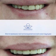 Изготовление металлокерамической конструкции